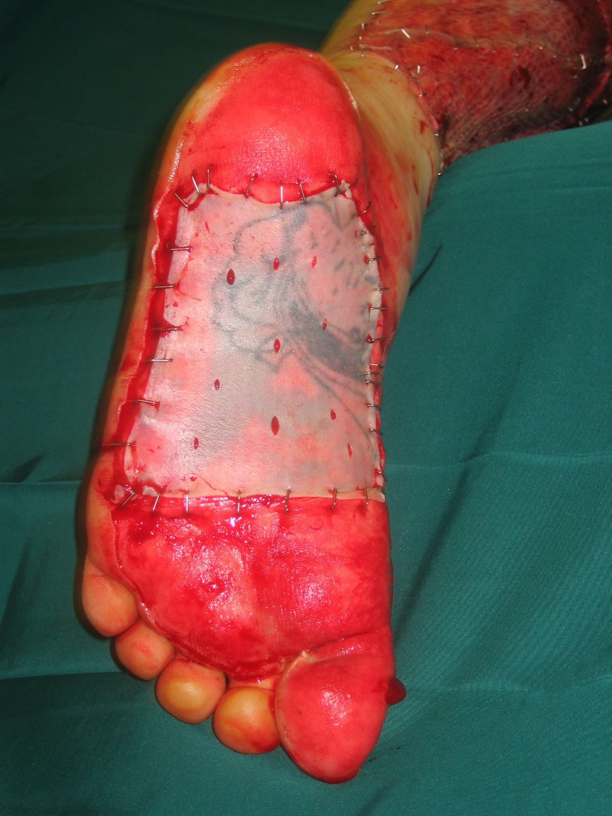 Hauttransplantation an der Fußsohle