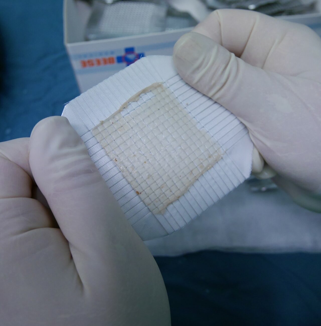 Skindot Hauttransplantationen SkinDot skindot-hauttransplantationen-skindot