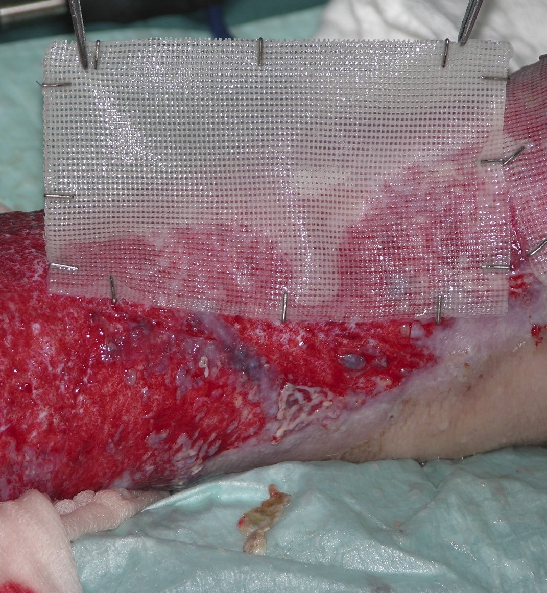 Hauttransplantation mit Keratinozyten