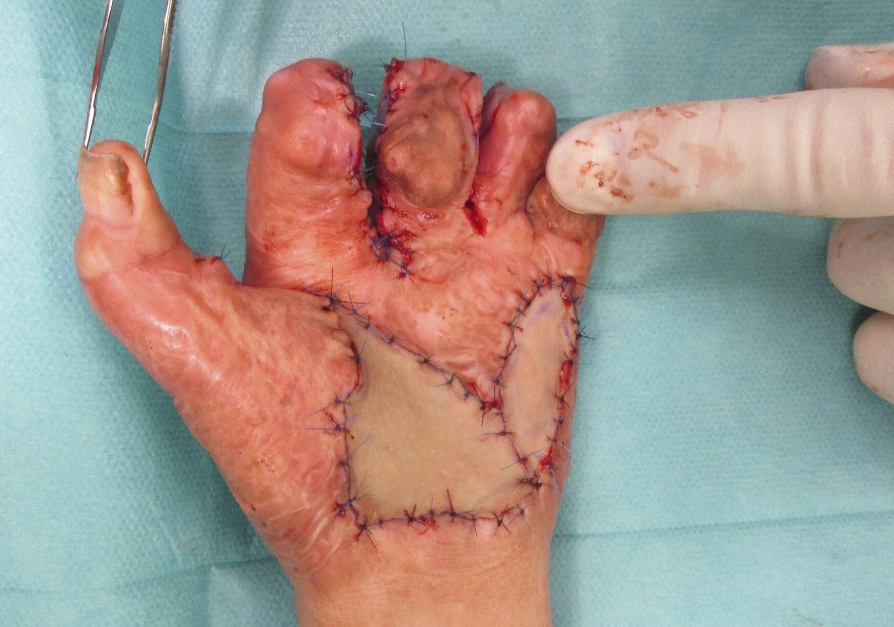 Vollhaut Transplantation an der Hand 