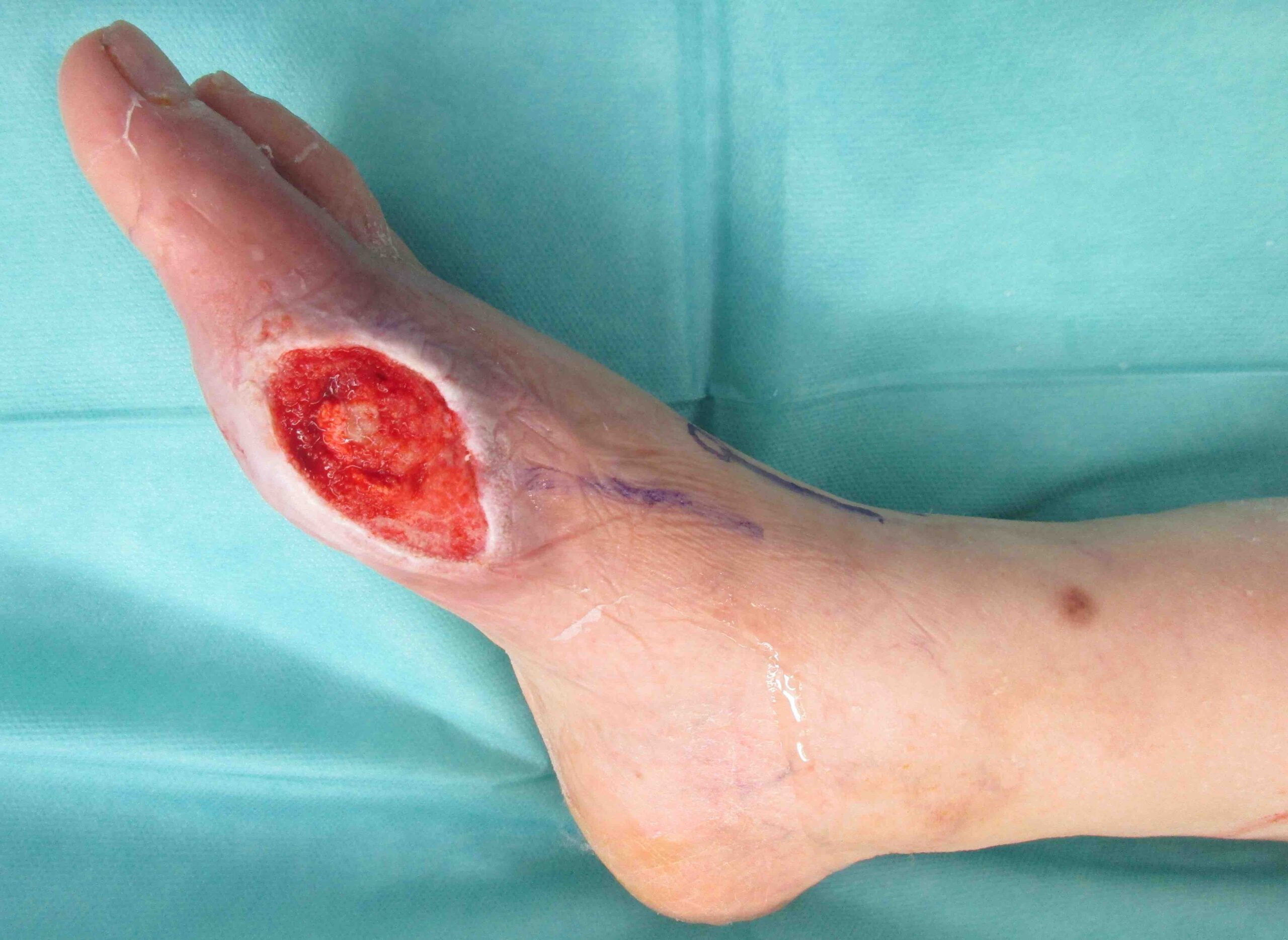 Chronische Wunde am Fuß zur Hauttransplantation mit SkinDot