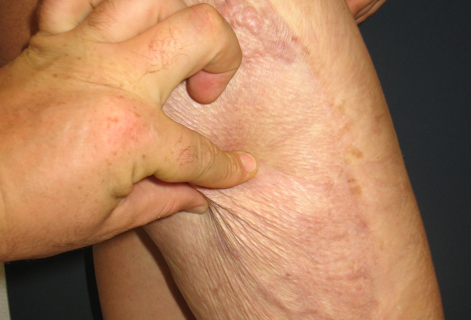 Die dermale Schicht dient als Dermiseratz und Verschiebeschicht nach Hauttransplantation