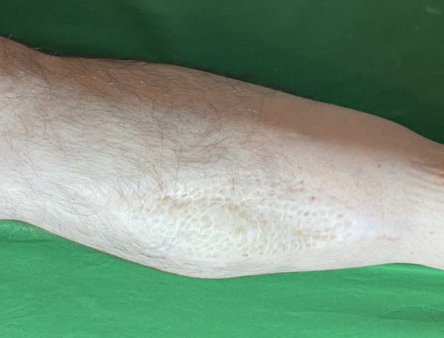 Hohe Belastbarkeit der transplantierten Haut geeignet für Hände, Füße und Amputationsstumpf