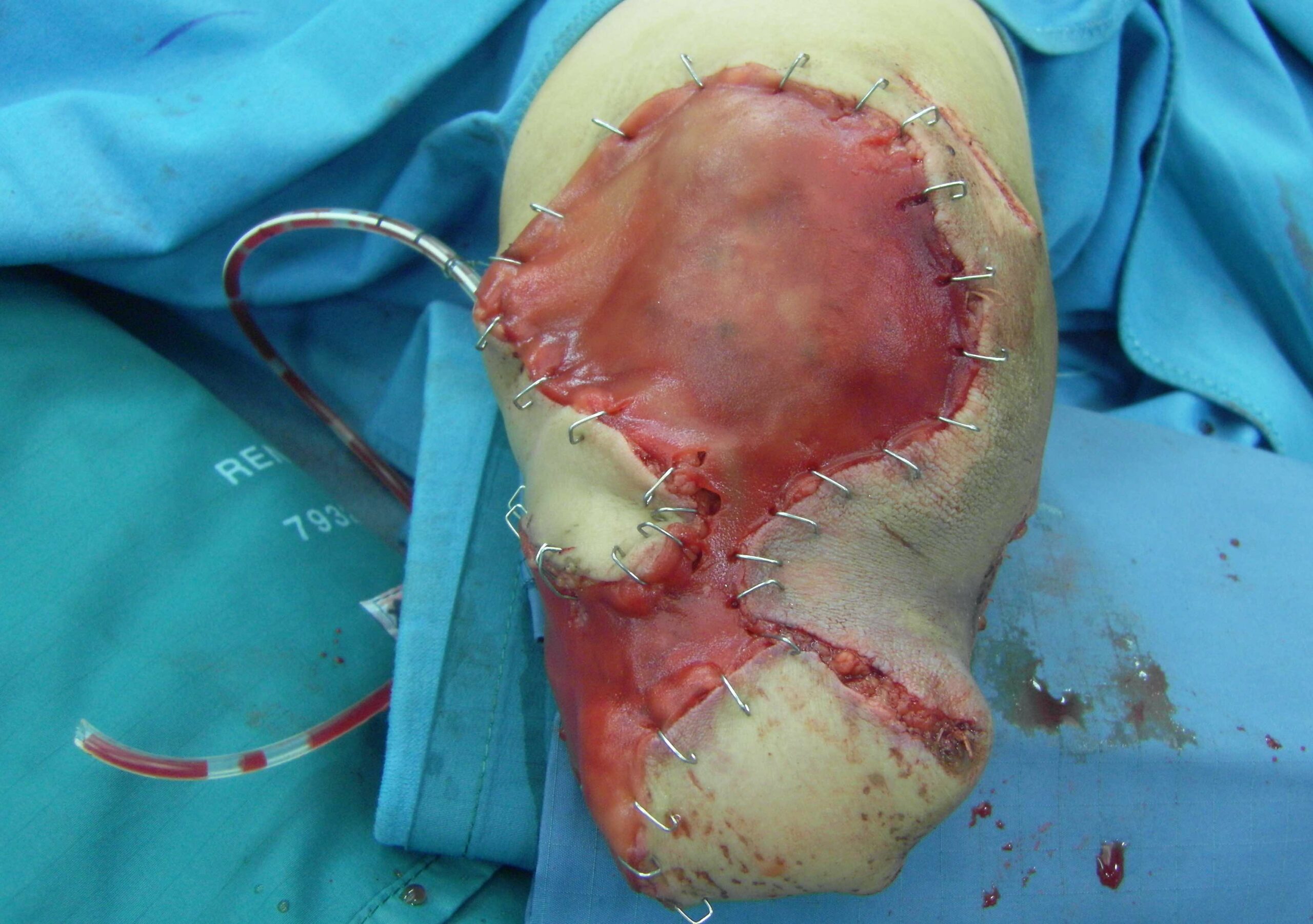 Chirurgische Transplantation Intagra Dermisersatz bei Hautwunden
