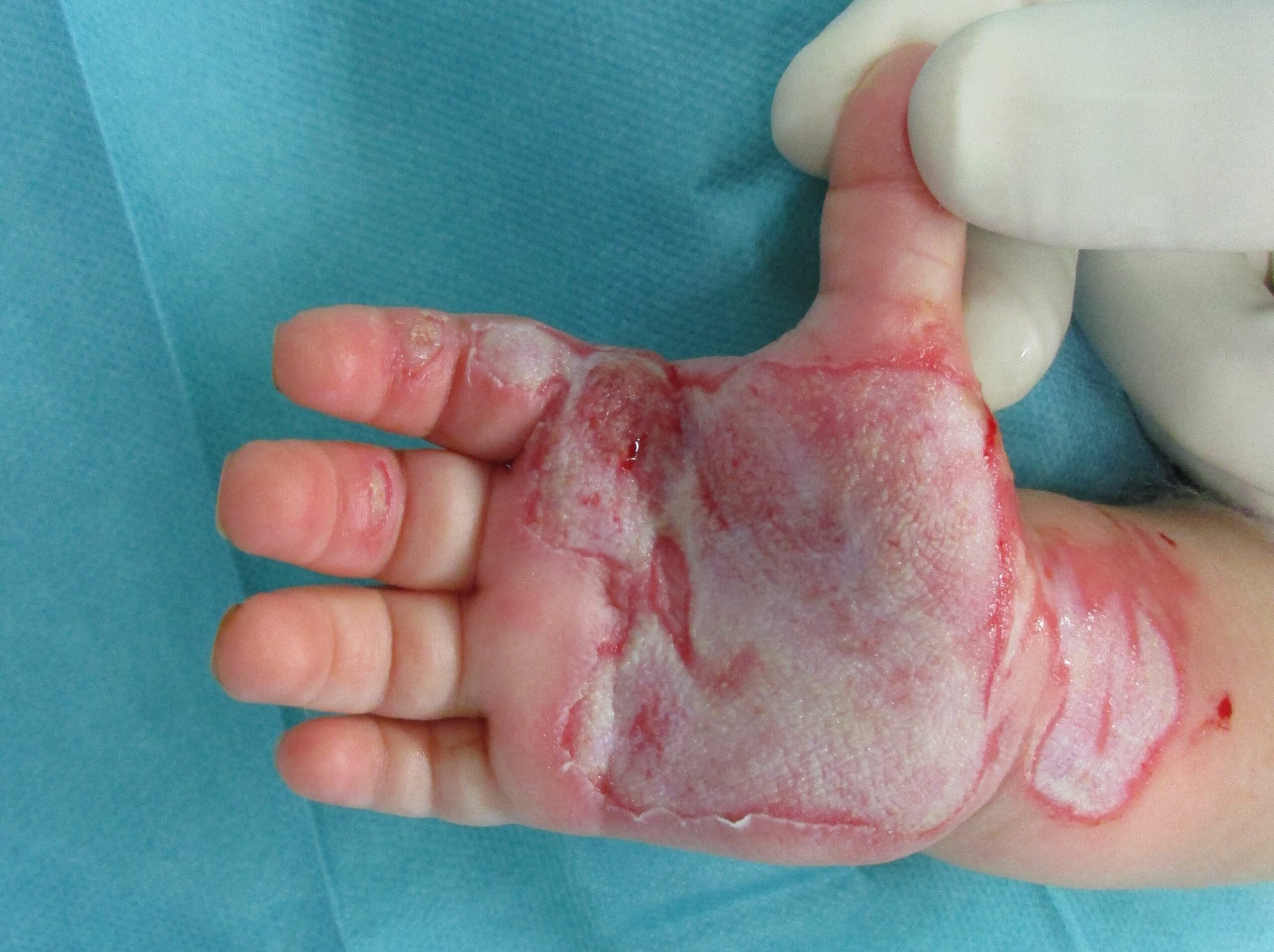 Minaturisierte Vollhauttransplantation an der Hand vom Kind