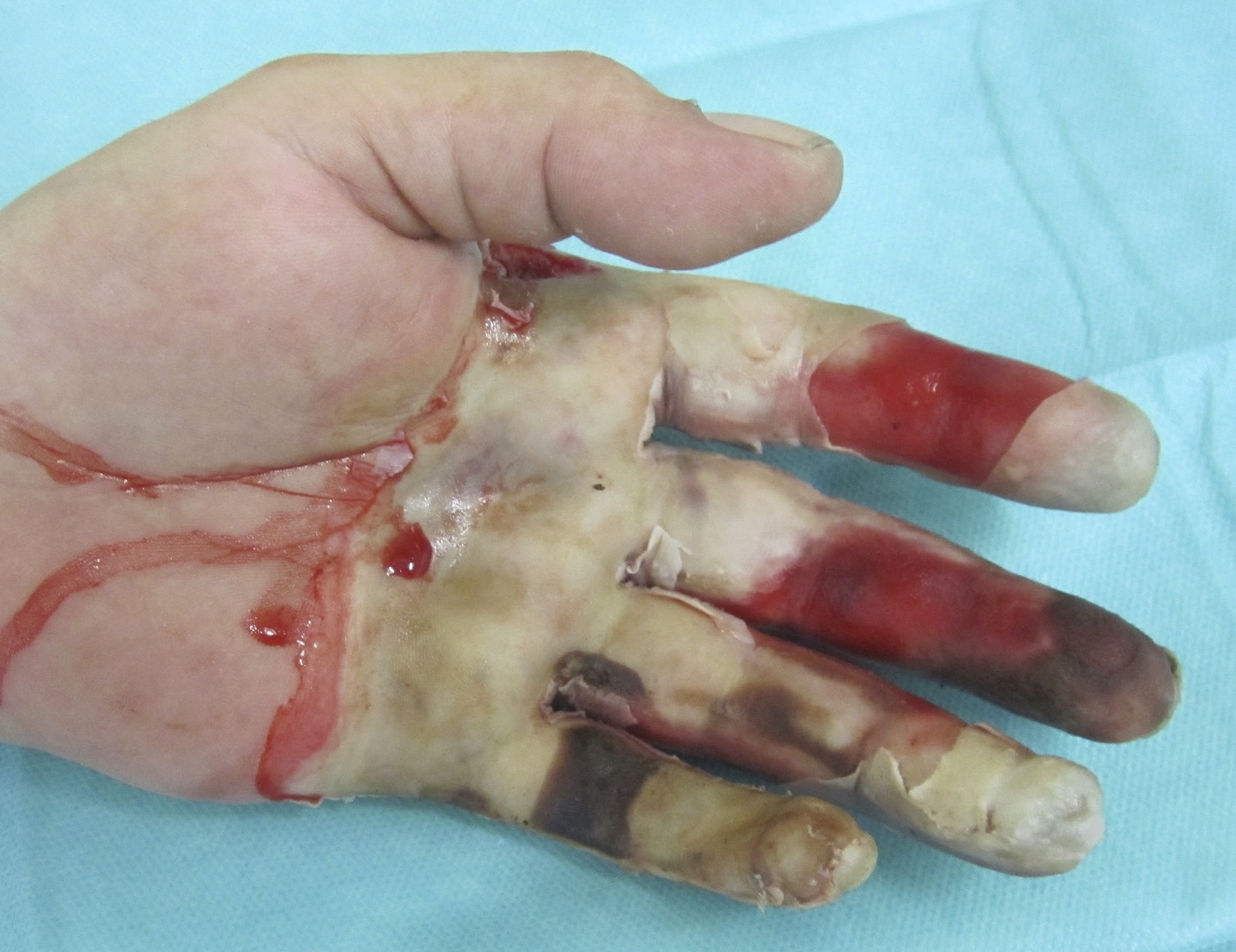 Skindot Indikation drittgradige Verbrennung linke palmare Handinnenfläche und Finger