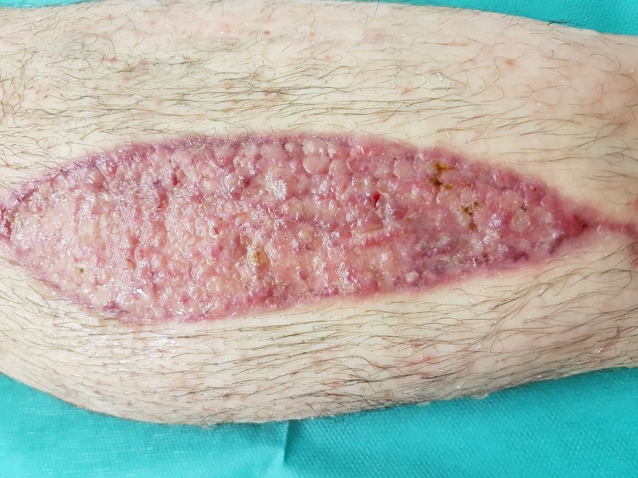 Skindot Vollhaut Hauttransplantation für tiefe Wunden