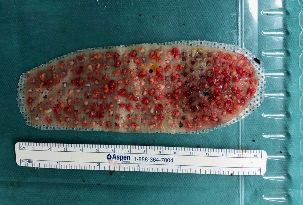 Hauttransplantation SkinDot Spalthaut Hautverpflanzung hauttransplantation-skindot-spalthaut-hautverpflanzung