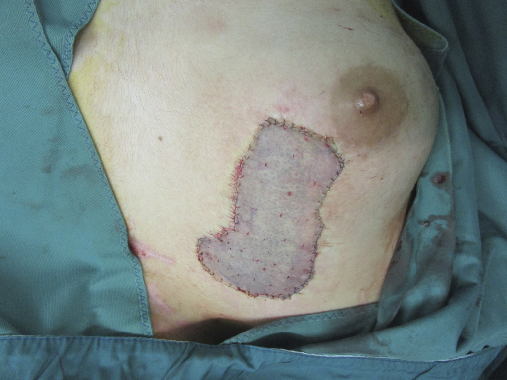 Spalthauttransplantation Sheetgraft auf Hautwunde