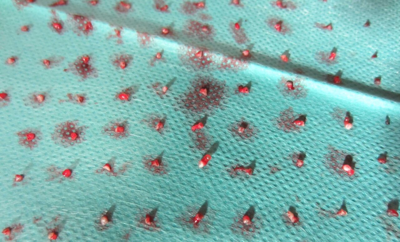 Hautersatz durch SkinDot⎪Fachinformationen