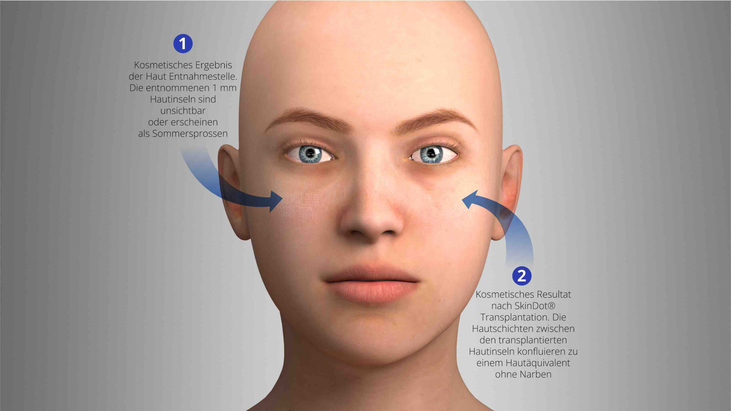 SkinDot Hauttransplantation kosmetisches Ergebnis